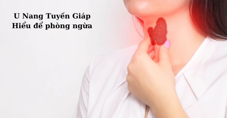 U nang tuyến giáp, hiểu để phòng ngừa