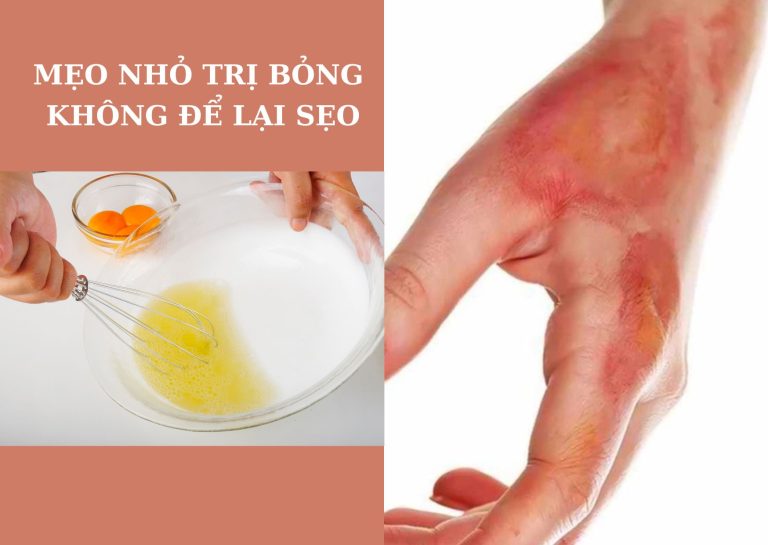 MẸO NHỎ TRỊ BỎNG KHÔNG ĐỂ LẠI SẸO