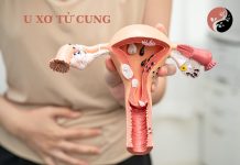 U XƠ TỬ CUNG U xơ tử cung